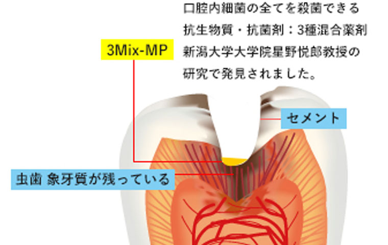 薬で治す無痛歯科治療