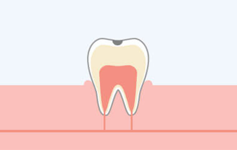 虫歯の進行と・治療方法