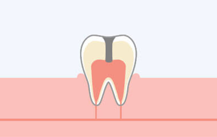 歯髄(神経)に達した虫歯