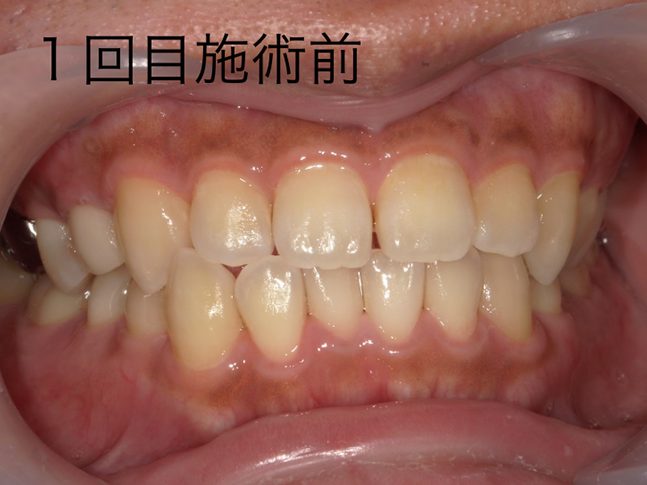 ホワイトニング症例治療前