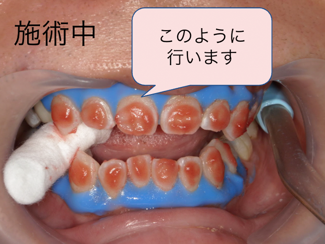 ホワイトニング症例治療前